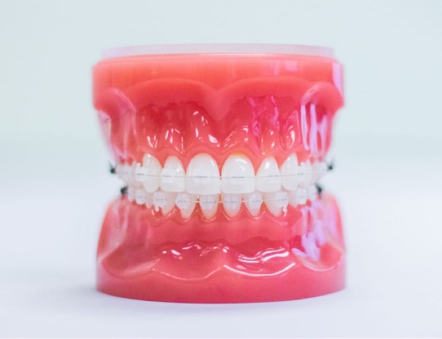 clear ceramic braces on model